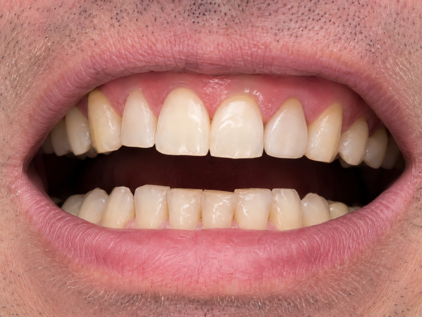 Case 2: Lost Crown or Filling Restoration — after