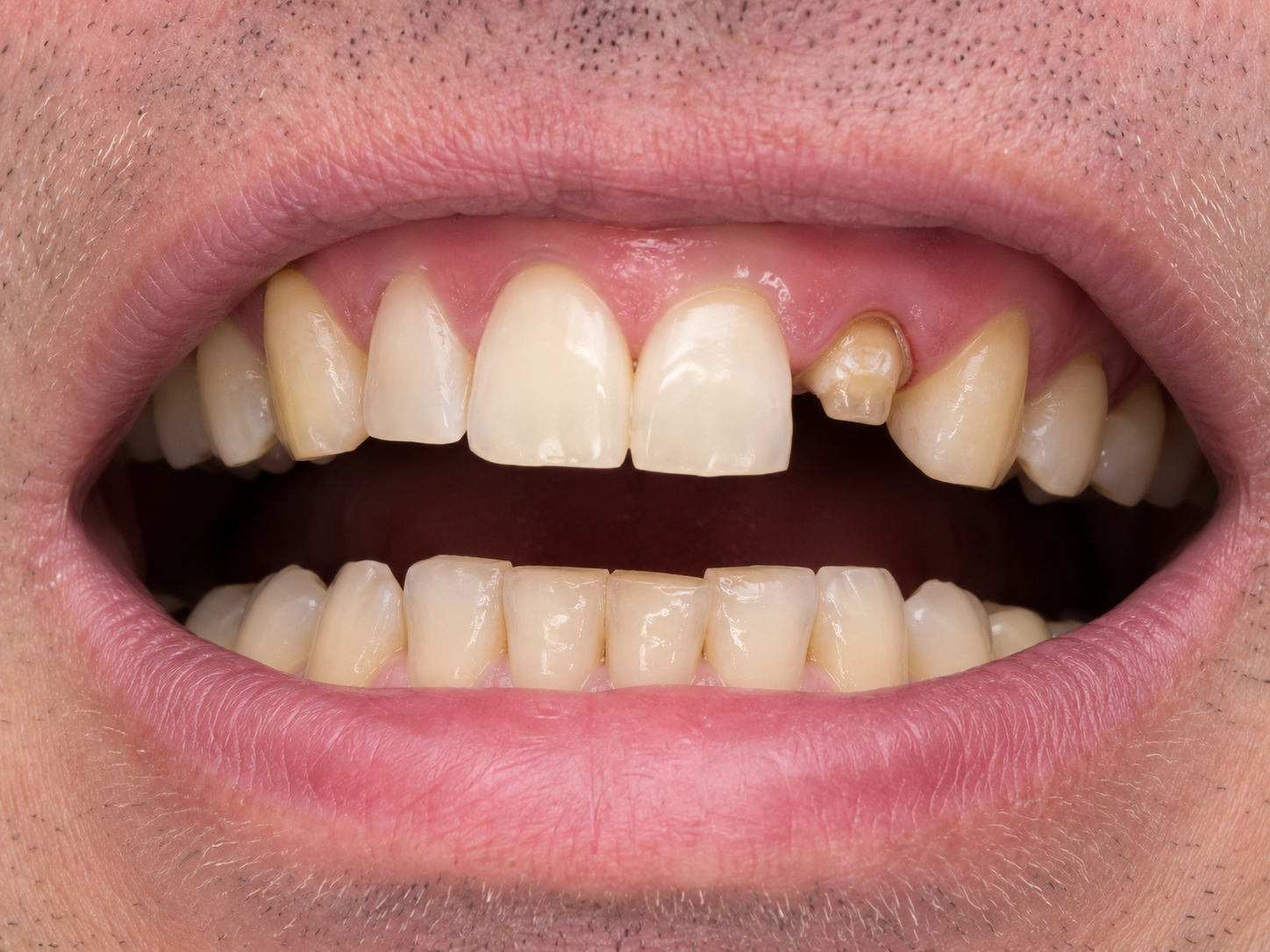 Case 2: Lost Crown or Filling Restoration — before