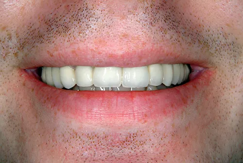 Case 3: Implant Restoration — after