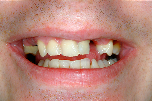Case 3: Implant Restoration — before